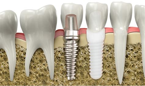  Zirconia: Unlocking Revolutionary Potential for Dental Implants and High-Temperature Applications!